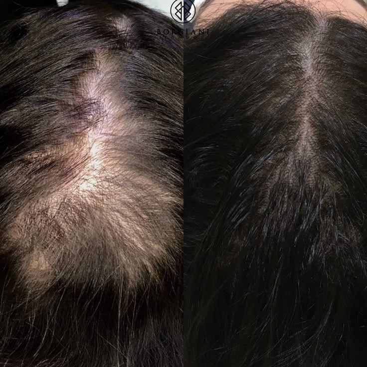 Hair Regrowth Treatment